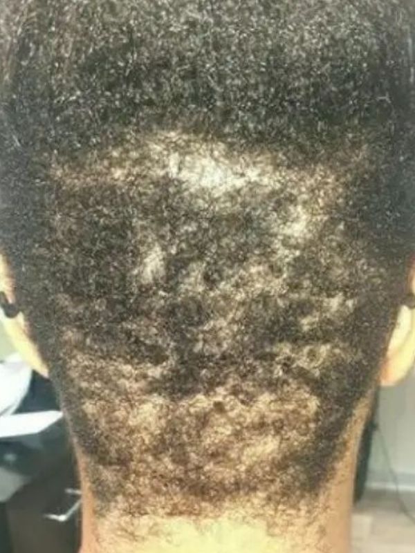 Before — Hair loss recovery progress